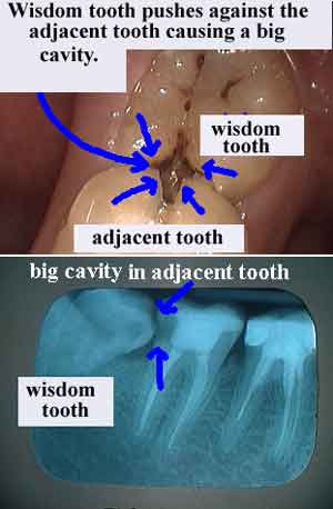 partial bony erupted wisdom tooth teeth impaction, impacted oral surgery, third 3rd molar