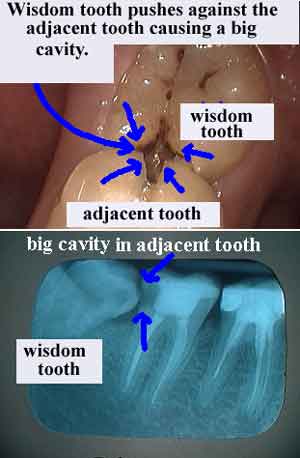 radiographic x-rays, xrays, wisdom teeth oral surgery surgical extraction x-ray xray tooth