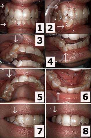 Malocclusion, dental bite teeth occlusion tooth class i II III, disharmony occlusal analysis