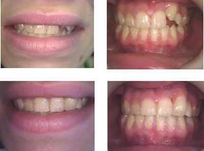 Porcelain Veneer Laminate, Gingival margins pink porcelain gum gums papilla cosmetic dental
