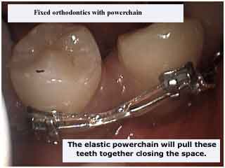 Elastics power chain in rotation orthodontistry via fixed cosmetic invisible clear braces.
