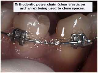 Orthodontist shows clear fastest braces that are invisible with elastics or powerchain space closure.