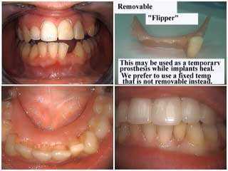 space maintenance dental implants orthodontics braces flipper removable denture