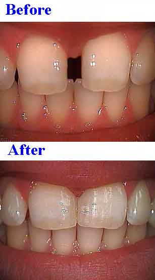 Space, tooth, dental bonding to close teeth spaces gaps, diastema, cosmetic dentistry