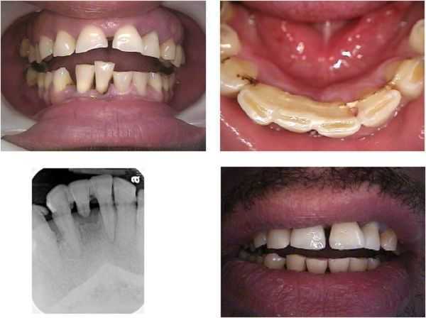 splint teeth for gum disease, periodontal splinting, bonding, false tooth, pontic