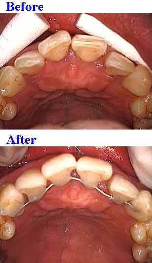Splint teeth tooth splints dental splinting extracoronal intracoronal stabilization loose mobility