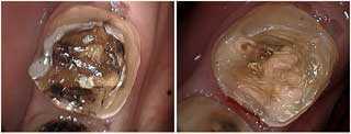 stains, tooth color staining, silver amalgam filling color cavity decay caries