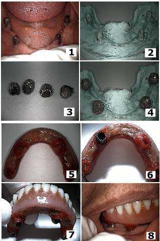 Subperiosteal dental Implant, Telescopic Coping, Telescope, Fixed-Removable, hybrid parallelism