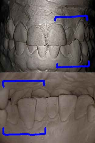 Study Models in dentistry, plaster stone dental casts diagnostic, master models, crossbite, bite