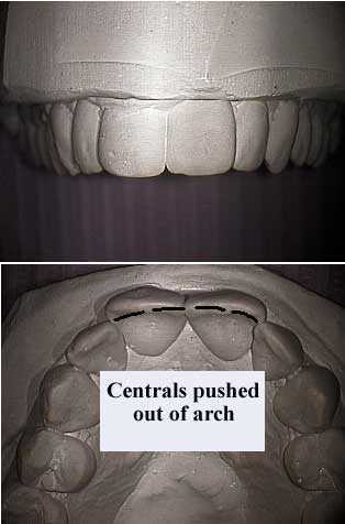 dental arch form, narrow tooth arch, orthodontists, teeth braces, constricted jaw, thumb sucking