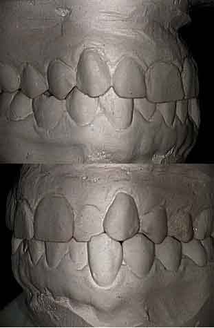 study models, plaster casts, malocclusion, crossbite, cross bite, cross-bite, tooth, teeth, dental