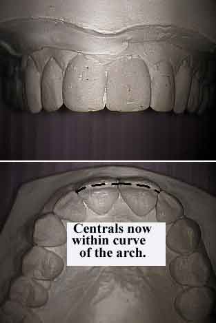 Fixed accelerated faster braces for a constricted jaw or arch.