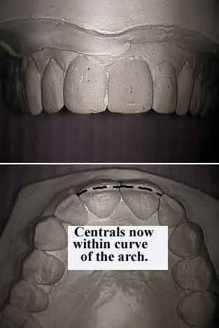 smiles, smiling, face facial proportion esthetics cosmetics aesthetics study models jaw constriction