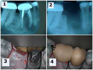 semi precision Attachment  precision, occlusal rest seat, fixed dental bridgework