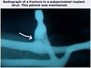 Dental Implant, subperiosteal implant, radiograph, x-ray, xray, strut fracture, hybrid