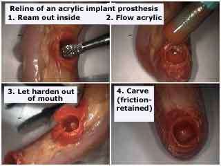 Oral Implants, dental prosthesis, subperiosteal, acrylic reline technique, repair fix broken