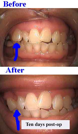 supernumerary teeth bonding gaps to close spaces spacings