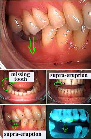 supraeruption, supra-eruption, tooth growing out of gum jaw bone, hypereruption