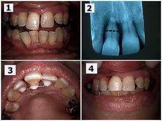 complications, fixed porcelain dental bridges, front tooth loose mobility mobile fremitus diastema