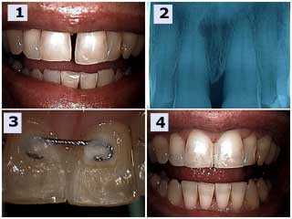 Splint teeth tooth splints dental splinting extracoronal intracoronal diastema space gap loose
