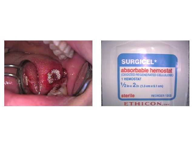 Surgicel,absorbable hemostat, oxidized regenerated cellulose, stop bleeding blood, cut cheek lip ton