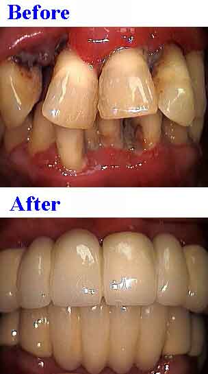 dentist bridges, gums, periodontics, caps, gingivitis, periodontitis, abutments, oral reconstruction