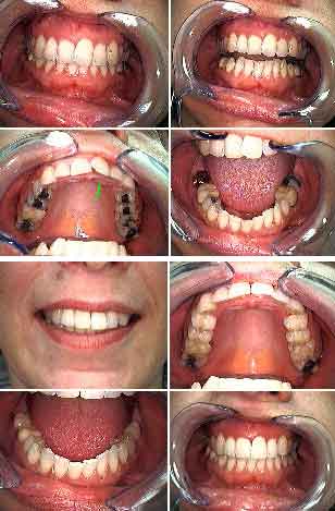 teeth bonding Before and After pictures cosmetic bonded, photographs, photos, composite resins