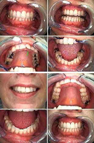 tooth decay crown before and after photos pictures, recurrent cavities dental caries crowns teeth caps