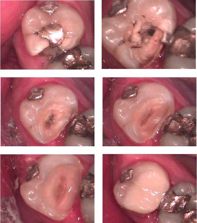 teeth bonding restorations, composite resin tooth fillings, deep cavity, composite resins, cosmetic