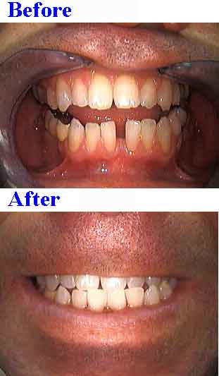 teeth bonding gaps, resins, white tooth filling gap smile