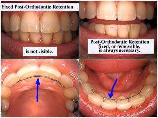 protruding-wire - Cream Ridge Orthodontics