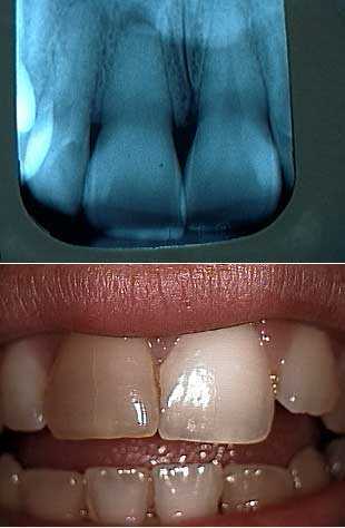 calcification teeth calcified tooth discoloration trauma hemosiderin dentinal tubules blocked