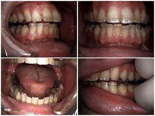 bruxism, grinding teeth clenching night guard nocturnal bite plate, disocclusion, lateral excursion