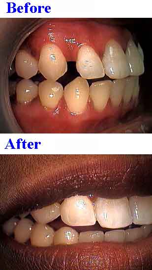 teeth gap bonding gaps to close tooth spaces, white fillings