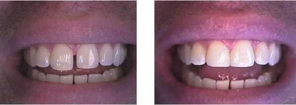 NY Cosmetic Dentistry bonding closes a teeth gap between front teeth