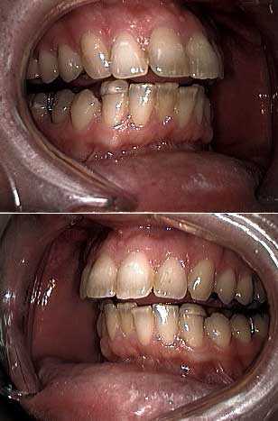 bruxism, TMJ stabilizing appliance, bite plates appliances, night sleep occlusal guard treatment