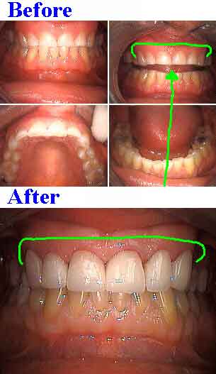 Porcelain veneers for short teeth, teeth veneers lengthen short tooth veneer chips cracks broken