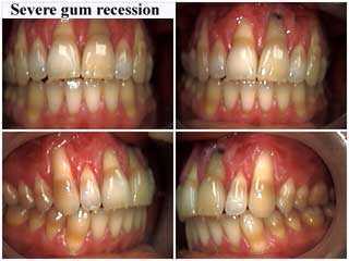 mucogingival involvement, gingival recession gum loss, mucogingival junction