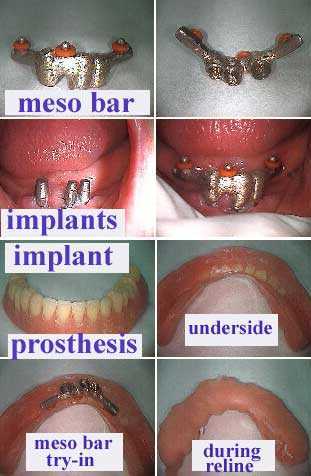 teeth implants, hybrids implant denture prosthetics, meso bar, Lew attachment, photos