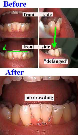 dental bonding for crowding, tooth colored white cosmetic tooth bonding
