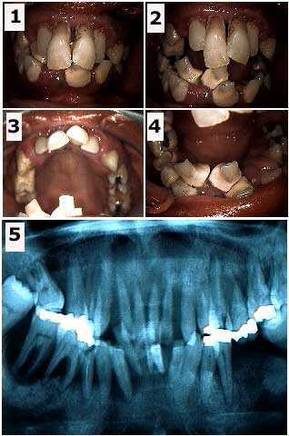 Scaling and Root Planing, periodontal SRP, phobic smile makeover reconstruction