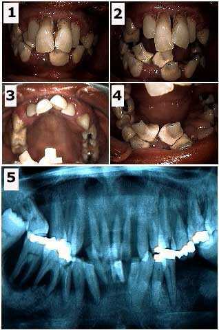 moderate periodontitis radiograph