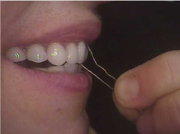 teeth used to open bobby pin habit, broken porcelain veneers tooth fracture habits 