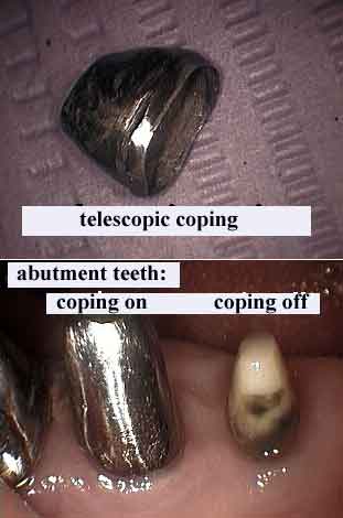 Telescopic Copings, telescopes, periodontal prosthesis, telescopic dental implant prosthetics