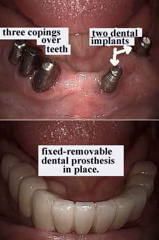 dental implants, temporary cement crowns teeth bridges, hybrids, telescopic coping, telescope