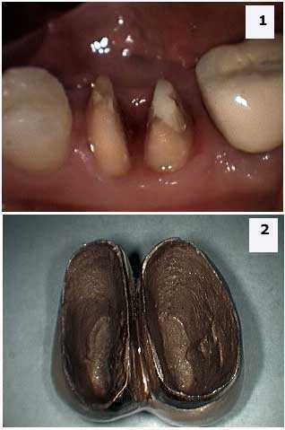 Dental Ceramic Crowns, caps, PFM Hemisection, Furcation, Telescopic Coping, hemisected molar tooth