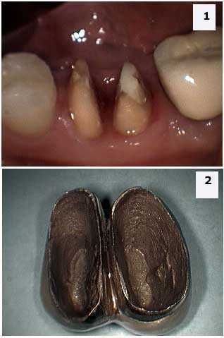 Telescopic Copings, telescopes, periodontal prosthesis, Hemisection, Furcation, parallelism