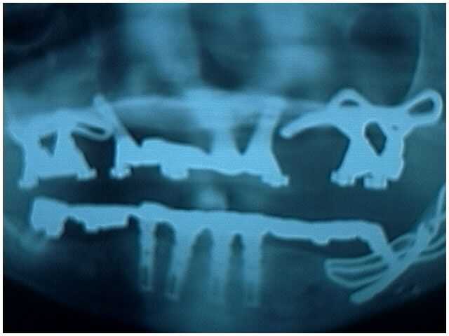panoramic x-ray xray radiograph dental digital x-rays xrays panorex dental implants Subperiosteal