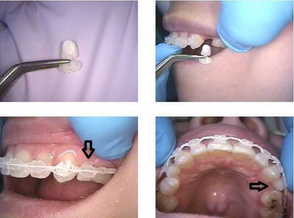 temporary crown cap close gap space between teeth dental braces orthodontics