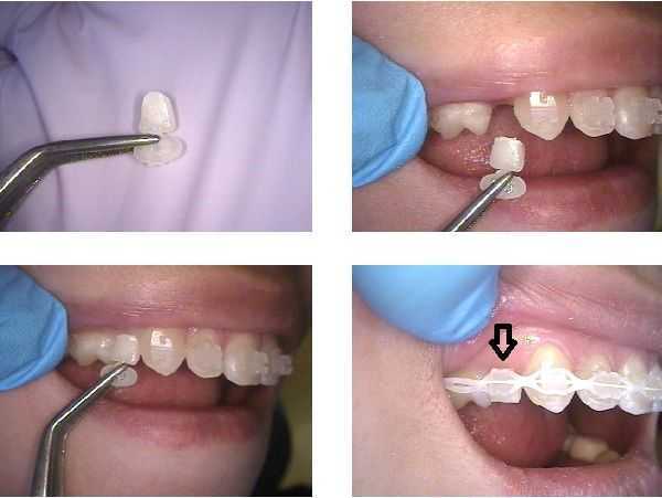 temporary crown cap close gap space between teeth dental braces orthodontics